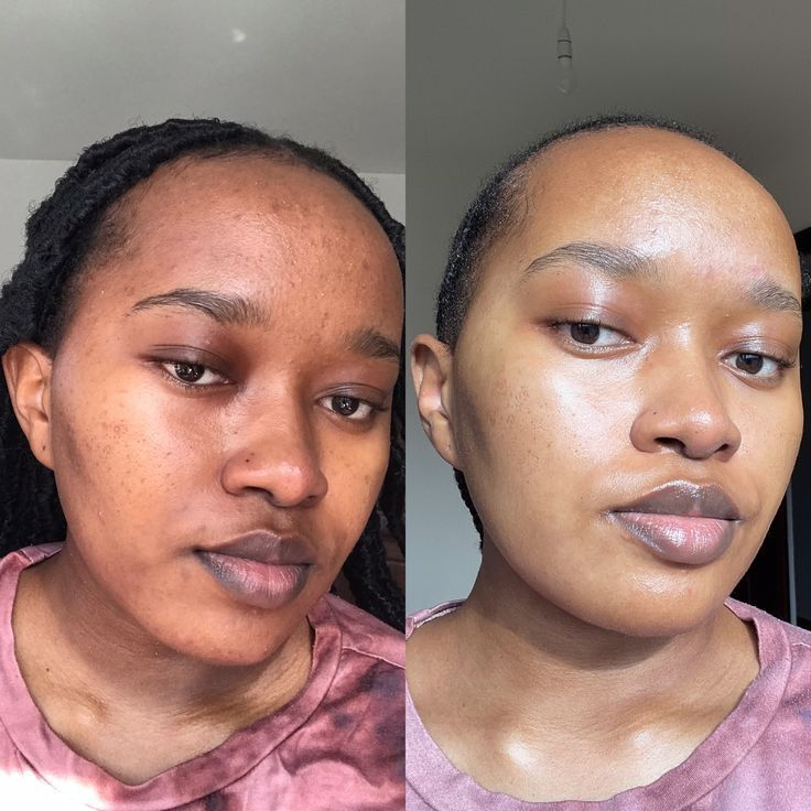 Hyperpigmentation