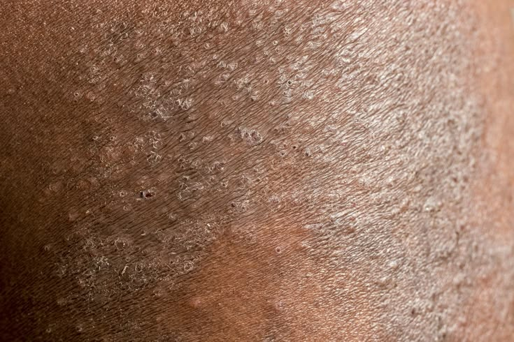 Chronic plaque and scaling skin condition before treatment